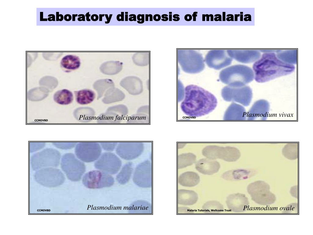 Малярия является антропонозом. Плазмодиум малярия,Вивакс и фальципарум. Малярия фальципарум. Plasmodium falciparum характеристика. Плазмодий овале Вивакс.