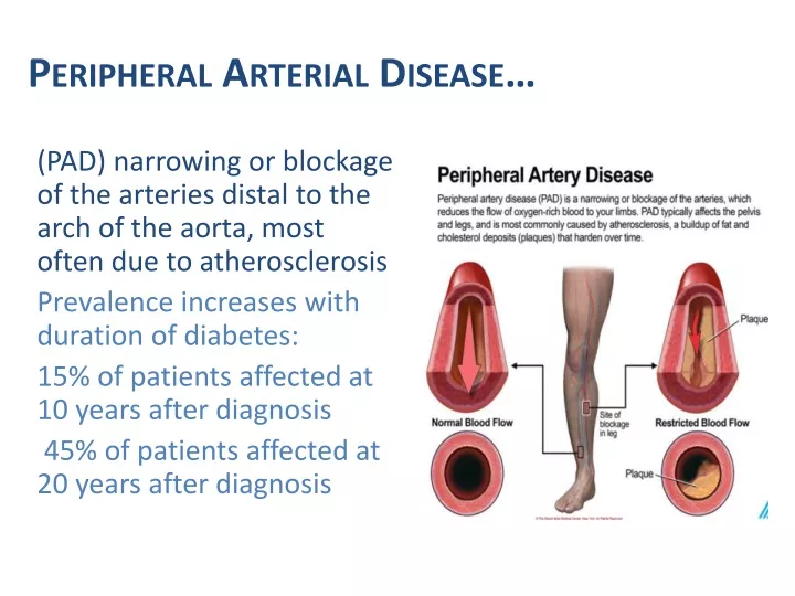 PPT - Peripheral Arterial Disease… PowerPoint Presentation, free ...